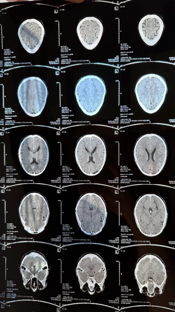 Brain scan after kitesurf injury