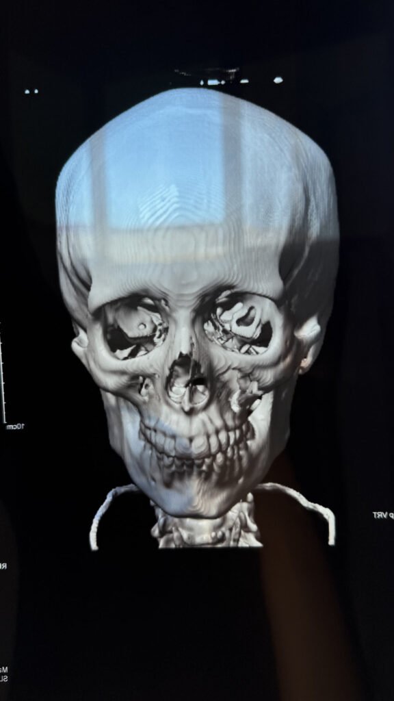 Radiology after Kitesurf Fall